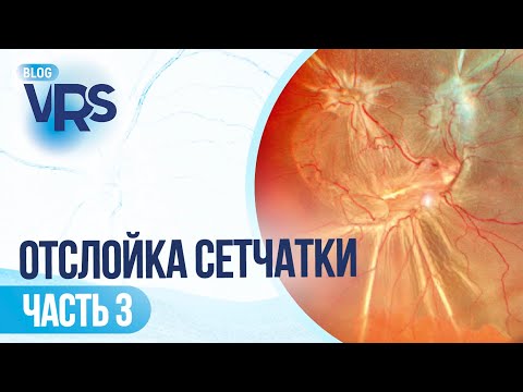 Видео: Отслойка сетчатки / часть 3