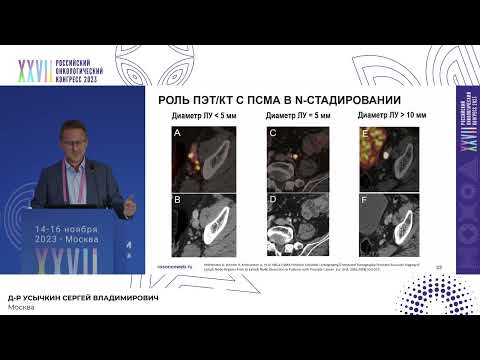 Видео: Элективное профилактическое облучение регионарных путей лимфооттока в лучевой терапии РПЖ