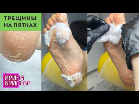 Видео: Убираем трещины на пятках 🌸 Препаратный педикюр 🌸 Педикюр дисками 🌸 Ирина Брилёва