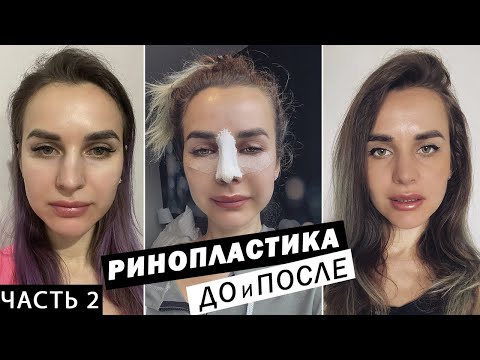 Видео: РИНОПЛАСТИКА в Санкт-Петербурге | До и ПОСЛЕ | Реабилитации после ринопластики. Часть 2