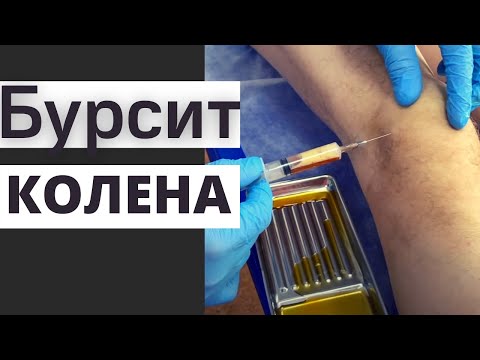 Видео: ПРЕПАТЕЛЛЯРНЫЙ БУРСИТ | Причины и Лечение| Доктор Юршин