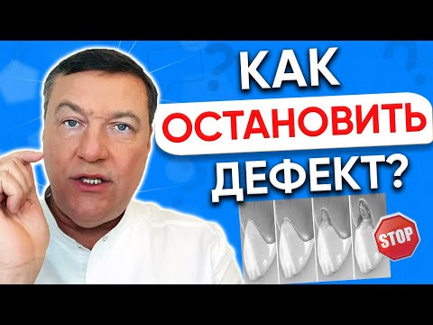 Видео: Клиновидный ДЕФЕКТ зубов лечение. Как остановить? Ставить ли пломбу?