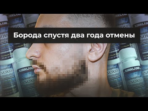 Видео: Борода спустя два года после отмены миноксидила