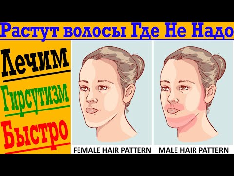 Видео: Растут волосы Где НЕ НАДО! Гирсутизим - избыточный рост волос!