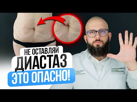 Видео: 5 ПРИЧИН СДЕЛАТЬ УШИВАНИЕ ДИАСТАЗА. Диастаз и его последствия