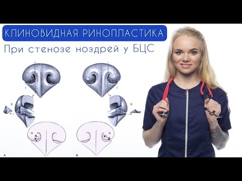 Видео: КЛИНОВИДНАЯ РИНОПЛАСТИКА - при стенозе ноздрей у БЦС