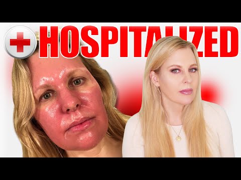 Видео: Лечение рака кожи синим светом Levulan / фотодинамическая терапия | Мой полный опыт