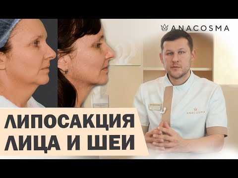 Видео: ЛИПОСАКЦИЯ ЛИЦА, ЩЕК, ВТОРОГО ПОДБОРОДКА 🔥  КОГДА МОЖНО, А КОГДА - НЕТ❓ПРОКОЛЫ☝🏻РЕАБИЛИТАЦИЯ