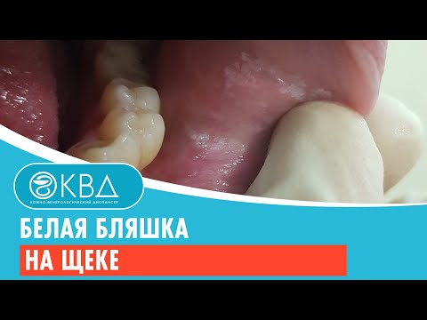 Видео: 🙁 Белая бляшка на щеке. Клинический случай №940