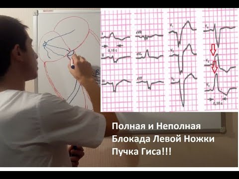 Видео: ПОЛНАЯ И НЕПОЛНАЯ БЛОКАДА ЛЕВОЙ НОЖКИ ПУЧКА ГИСА!!!