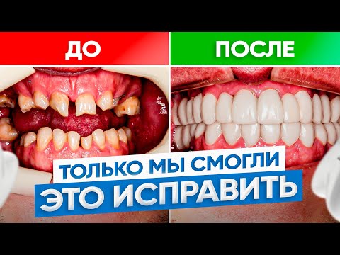 Видео: Их взяли только мы! Очень кривые зубы – ДО/ПОСЛЕ. Исправление прикуса брекетами