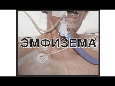 Видео: 02-09 Хроническая обструктивная болезнь легких.
