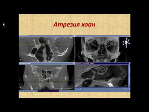 Видео: Зубарева А.А. «Диагностика полости носа и околоносовых пазух по данным КЛКТ»