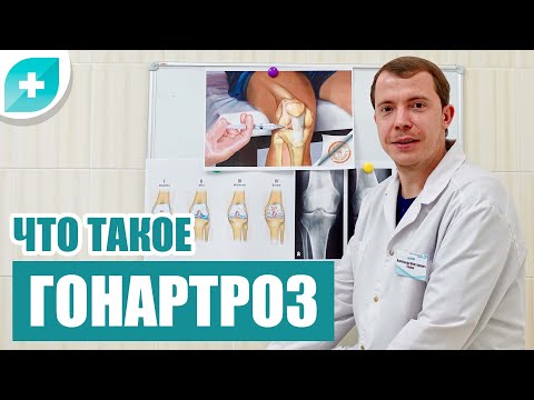 Видео: Что такое гонартроз.