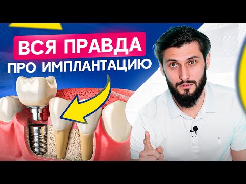 Видео: Посмотри это видео перед тем, как ставить ИМПЛАНТЫ. Стоматологи умалчивают об этом