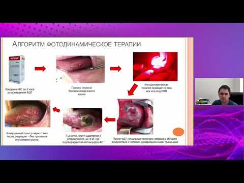 Видео: Фотодинамическая терапия рака слизистой оболочки полости рта