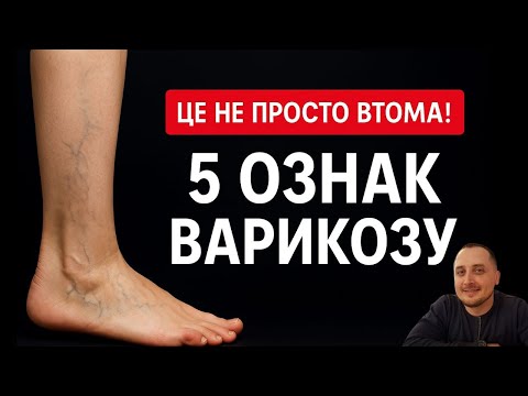 Видео: Втома чи перші дзвіночки варикозу? 5 ознак, що час діяти