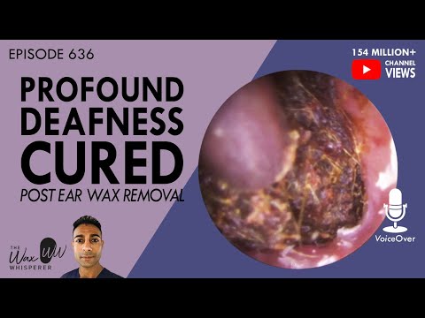 Видео: 636 - Глубокая глухота после удаления ушной серы