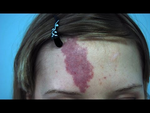 Видео: Красные Пятна На Лице. Почему Они Возникают? Гемангиома.Что Это Такое и Как лечить? Говорит ЭКСПЕРТ.