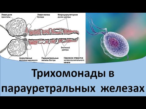 Видео: Трихомонады в парауретральных железах