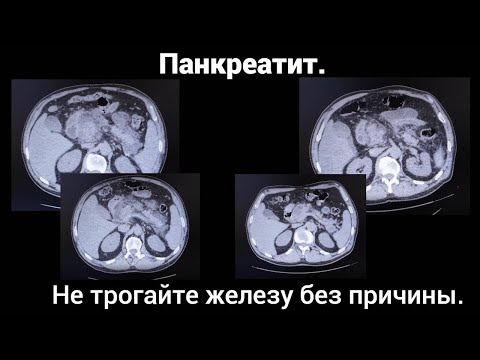 Видео: Панкреатит.  Не трогайте железу без причины