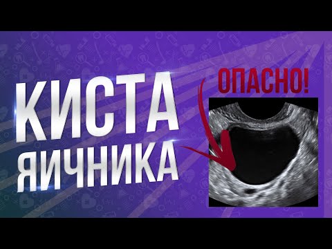 Видео: ОПАСНО! КИСТА ЯИЧНИКА! Чем грозит если не лечить?