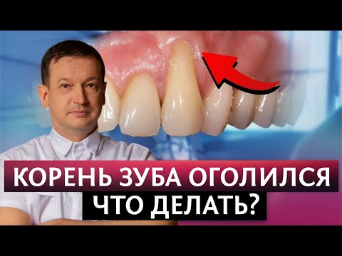 Видео: Шейка зуба ОГОЛИЛАСЬ ! Что делать с рецессией десны?