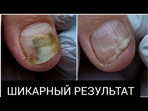Видео: ШОК ТРАВМА ногтя