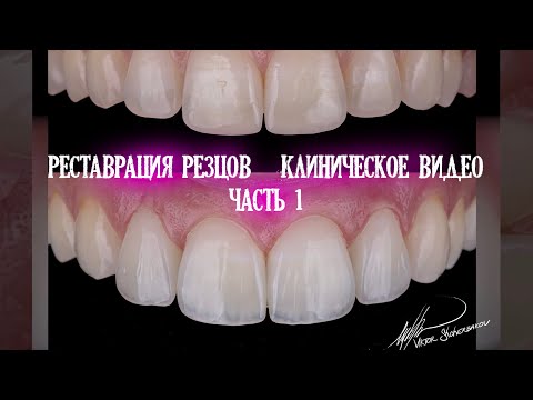 Видео: Реставрация фронтальных зубов. Клиническое видео. Часть 1