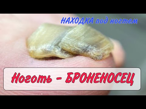 Видео: Волосы под ногтем / толстый ноготь / ретронихия / онихогрифоз