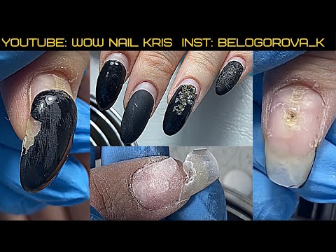 Видео: Расковыряла ноготь до деформации| Онихогрифозные ногти| Травма детства