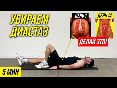 Видео: ДИАСТАЗ. Эффективный комплекс упражнений для уменьшения диастаза. Убираем диастаз за 5 минут в день