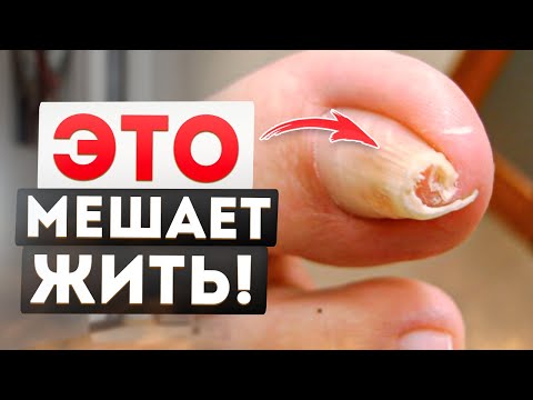 Видео: КАК ИЗБАВИТЬСЯ ОТ СКРУЧЕННОГО НОГТЯ! Причина БОЛИ в Ногах! (Простые Советы От Подолога)