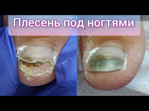 Видео: ПОЗЕЛЕНЕЛ НОГОТЬ, ЧТО ДЕЛАТЬ? ПЛЕСЕНЬ ПОД НОГТЯМИ. ОНИХОЛИЗИС НА НОГАХ. БОЛЯТ НОГТИ НА НОГАХ