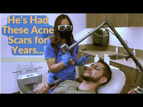 Видео: Полная демонстрация использования эрбиевого лазера для удаления рубцов от угревой сыпи у мужчин!
