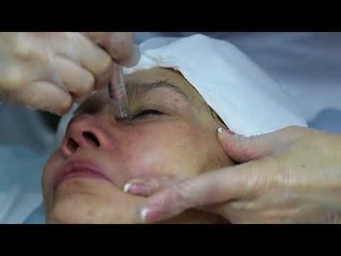 Видео: Фракционная мезотерапия аппаратом дермапен