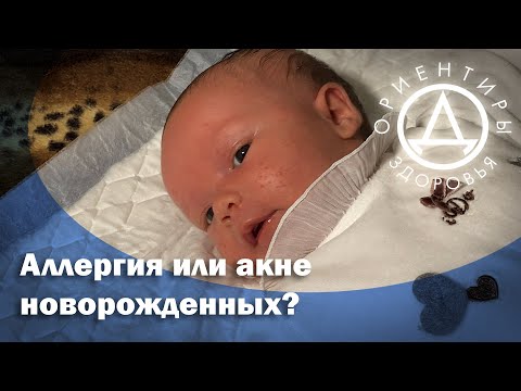 Видео: Аллергия или акне новорожденных?