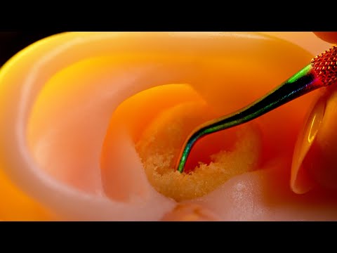 Видео: [ASMR] Глубокая чистка ушей для удаления большого количества ушной серы (No Wisper, Sub, ACMP)