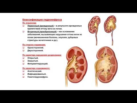 Видео: Ультразвуковая диагностика (УЗИ). Доктор Иогансен. Выпуск 84. Гидронефроз.