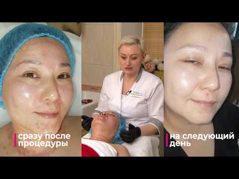 Видео: Фракционная мезотерапия лица и шеи  Результат До и После