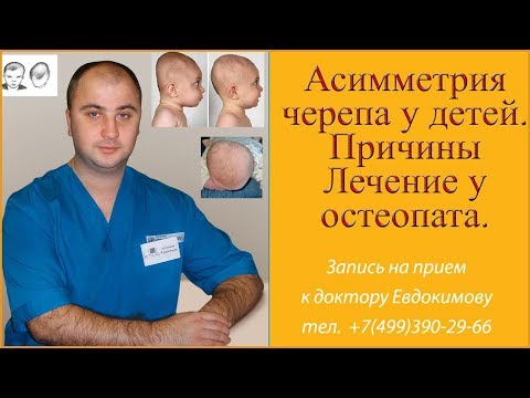 Видео: Асимметрия головы у ребенка. Причины.  Лечение остеопатией