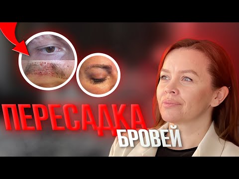 Видео: ПЕРЕСАДКА ВОЛОС БРОВЕЙ