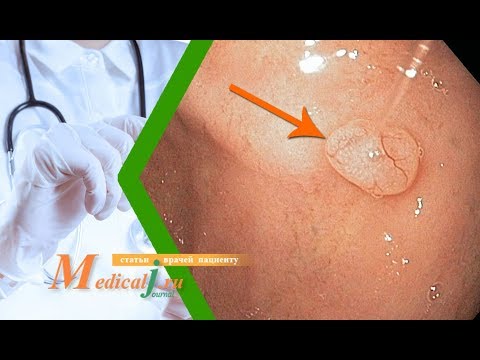 Видео: Полипы желудка. Что это? Как определить? Как лечить?