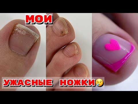 Видео: МОИ УЖАСНЫЕ НОЖКИ 😐 Педикюр на себе 🦶 Вычищаем подногтевую мозоль