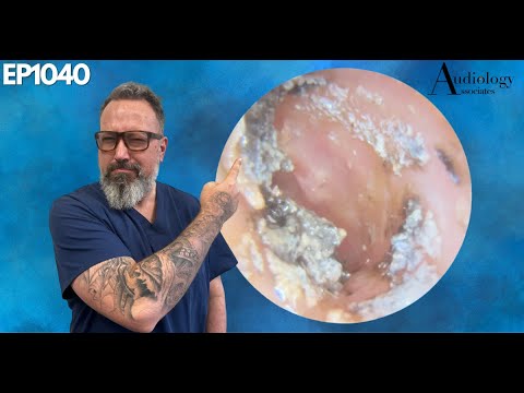 Видео: Удаление инфицированной ушной серы: ни с чем не сравнимое облегчение! - EP1040