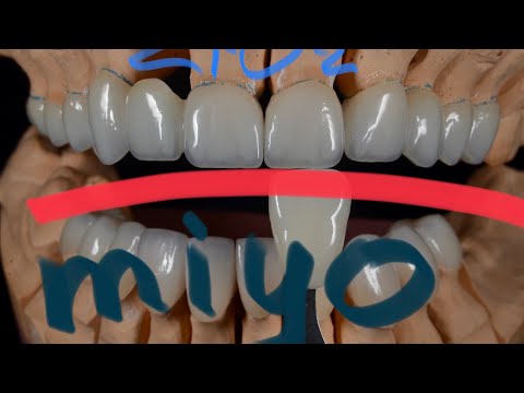 Видео: Циркониевые коронки, нанесение miyo. полное видео с озвучкой доступно спонсорам канала от 49р.