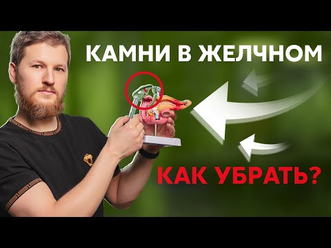 Видео: Камни в желчном пузыре - как убрать?
