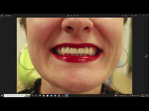 Видео: Протезирование цирконием - комбинированная работа - импланты и зубы,  безметалловая керамика