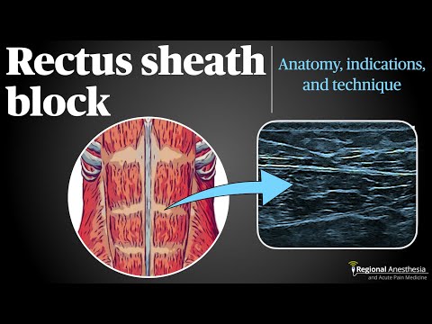 Видео: Блокада влагалища прямой мышцы живота