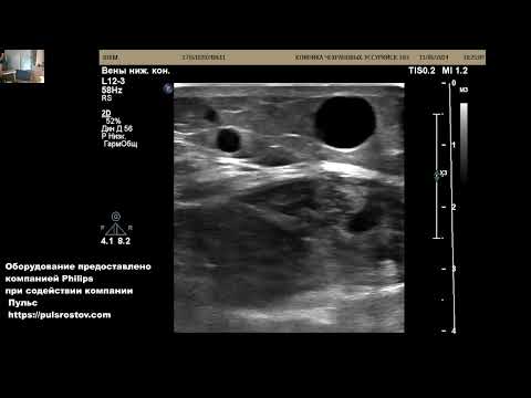 Видео: УЗИ вен нижних конечностей Уссурийск. Тромбоз вен + варикоз